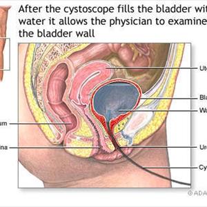 Uti Infection Symptoms In Women 