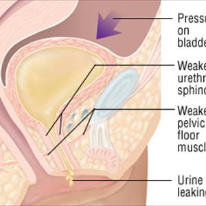 Herbal Treatment For Uti - Easy-To-Follow Tips To Prevent Urinary Tract Infection