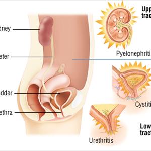 Burning After Urination Articles - Radiology Tests That Detect UTI Related Abnormalities