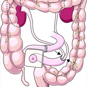 Bladder Inflammation Reason - What To Do When Urinary Tract Infection Antibiotics Don