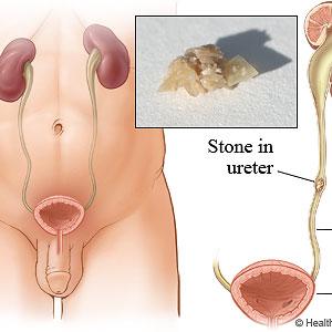  Different Stages Of Kidney Infections
