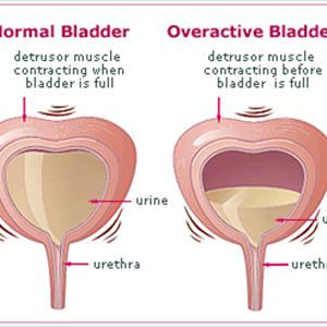 Urinary Tract Infections Images 